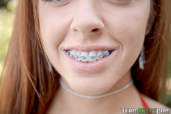 Braces Porn Pics At PornPicturesHQcom